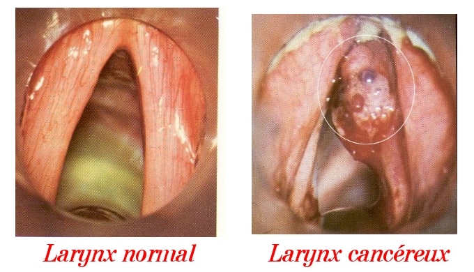 Le cancer du Larynx